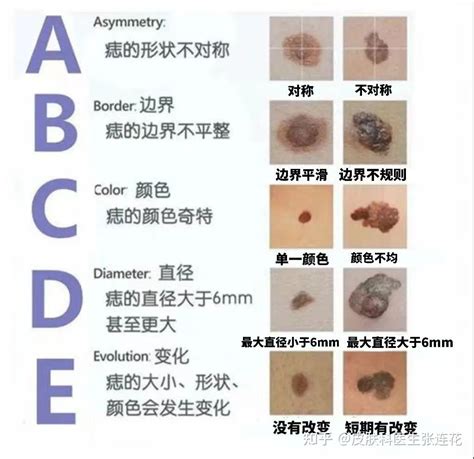 痣 斑|痣也可能会癌变！长在 3 个地方要注意